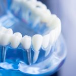 Czy implanty dentystyczne są zdrowe i bezpieczne?